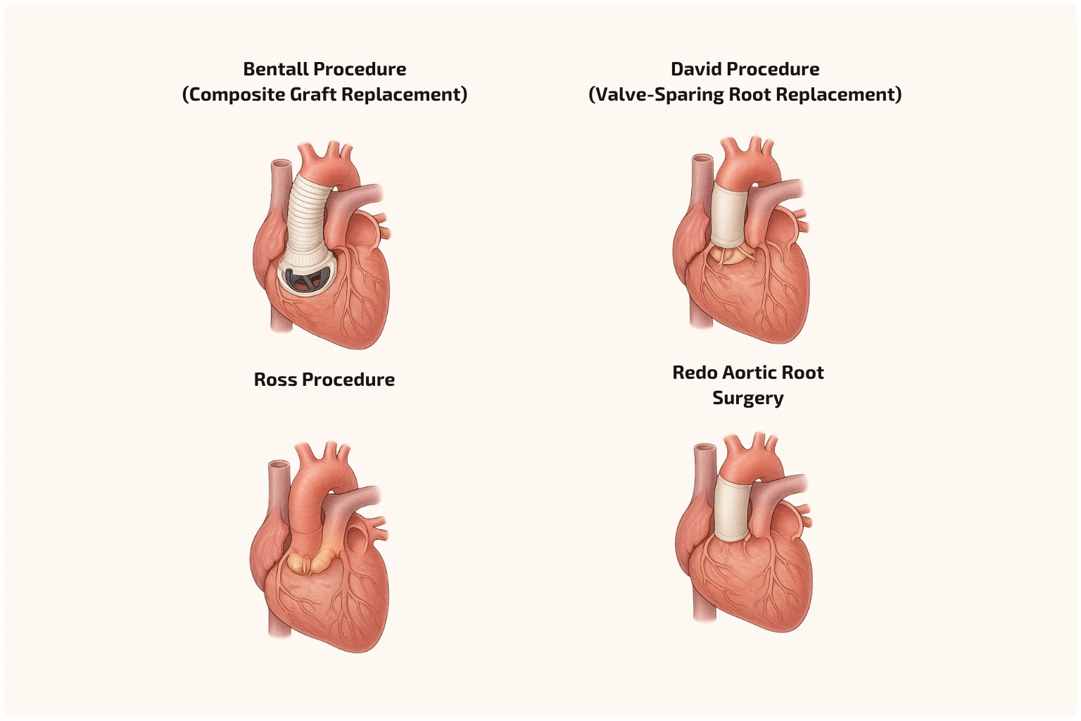 Aortic root surgery