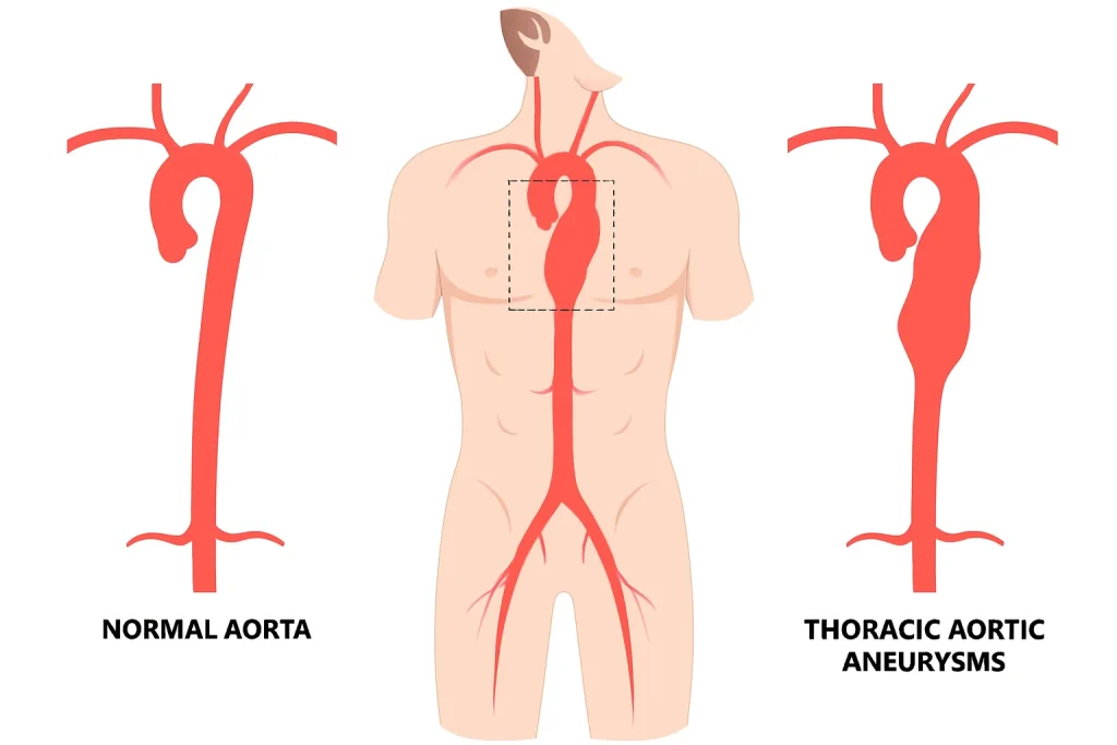 Aortic root surgery
